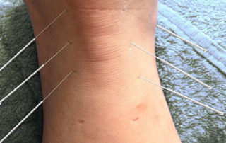 Acupuncture Geelong