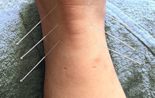 Acupuncture Geelong