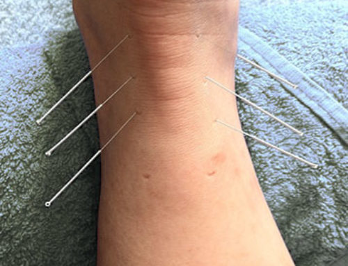 Chronic Pain and Acupuncture