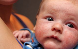 Eczema in Children